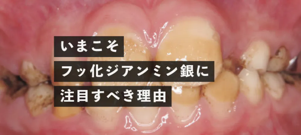 いまこそ フッ化ジアンミン銀に注目すべき2つの理由 歯科医師 衛生士 技工士向けsns 情報サイト1d ワンディー