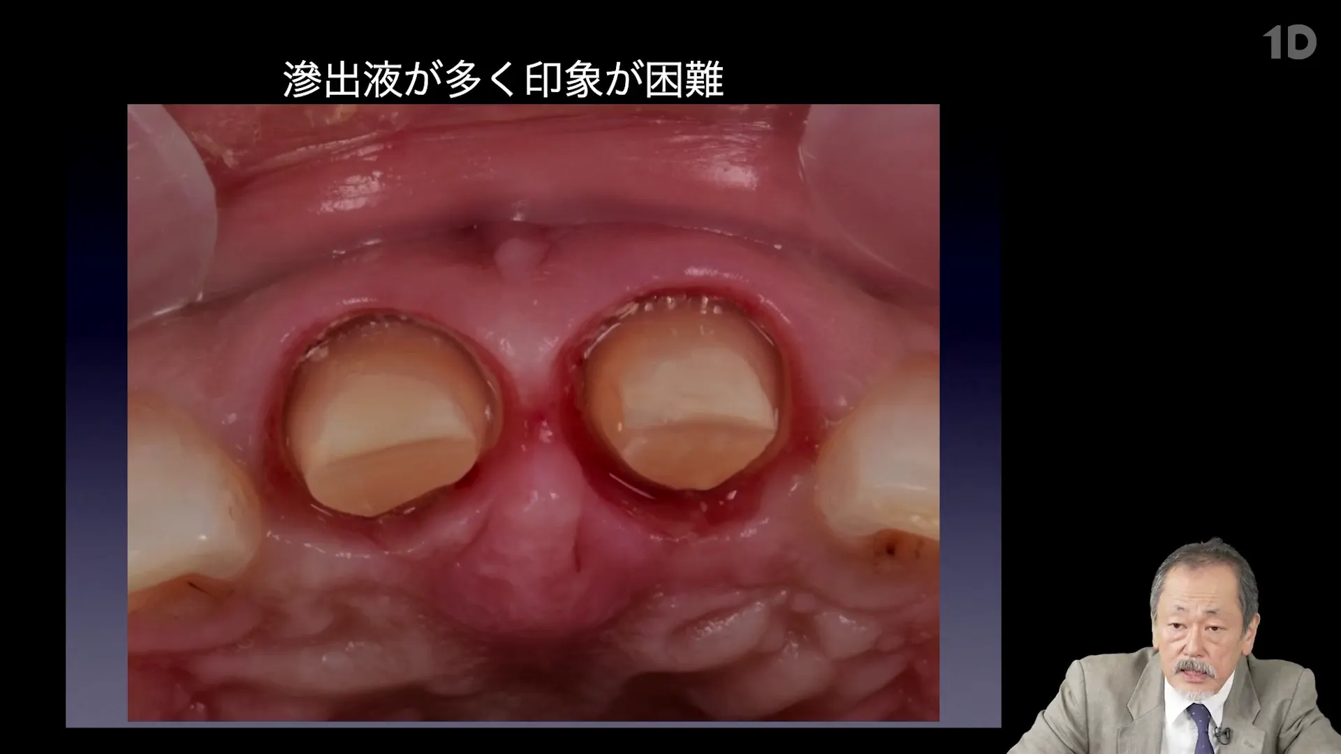 Dr.行田式「クラブリ臨床ゼミ」#4。クラウンブリッジの考え方と縁下