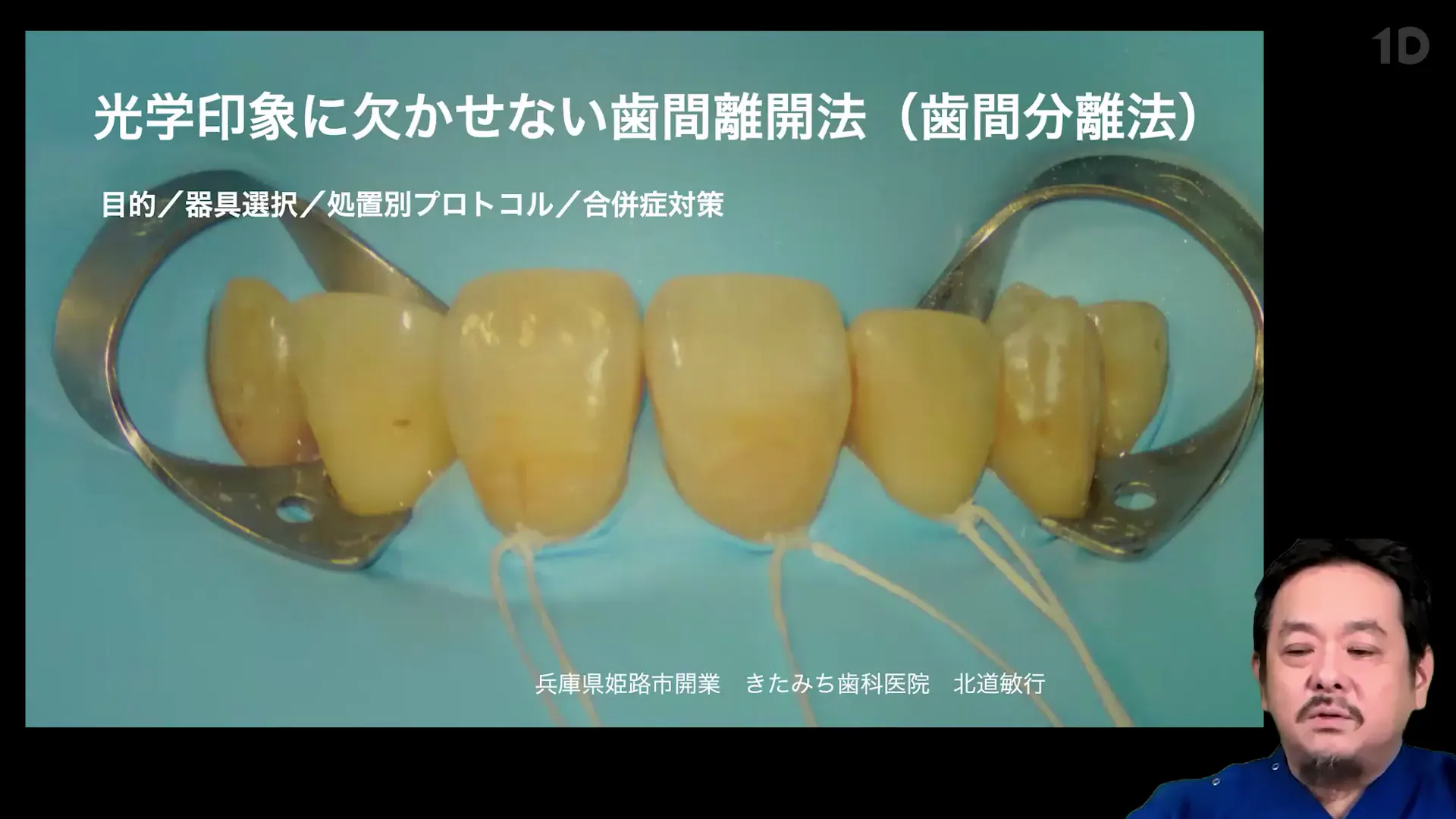 歯間分離をちゃんとやってこそプロフェッショナル｜歯科オンライン 