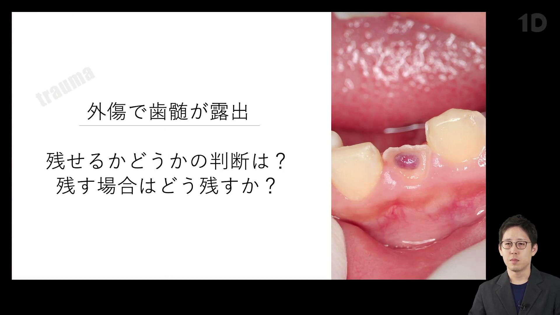 Vital Pulp Therapy」の理論と実際。症例で学ぶ歯髄温存の臨床