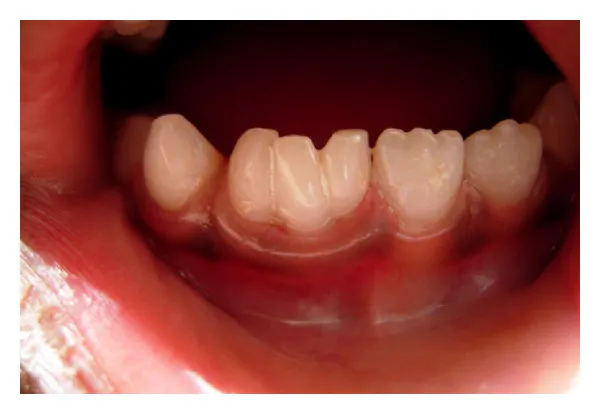 過剰歯  1D歯科用語辞典