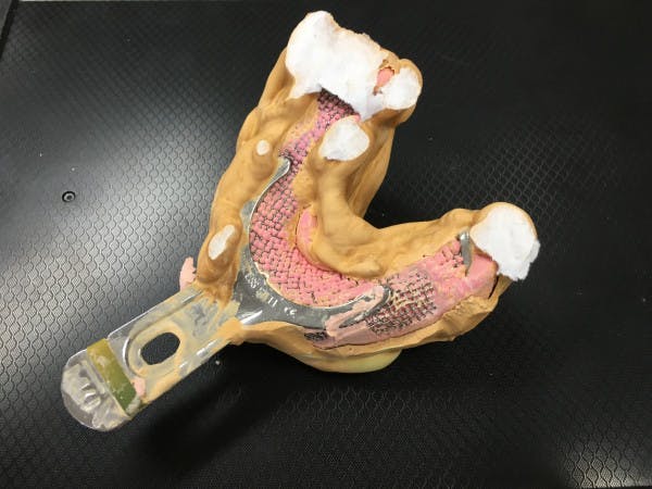 印象採得 1d歯科用語集