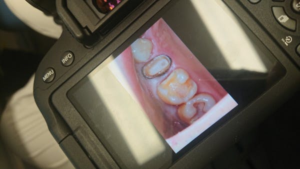 印象採得 1d歯科用語集