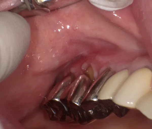 これもまた扁平苔癬 頬粘膜と15 16 17の歯肉の部分です ふわ ゆうさんの投稿 歯科医師 衛生士 技工士向けsns 情報サイト1d ワンディー