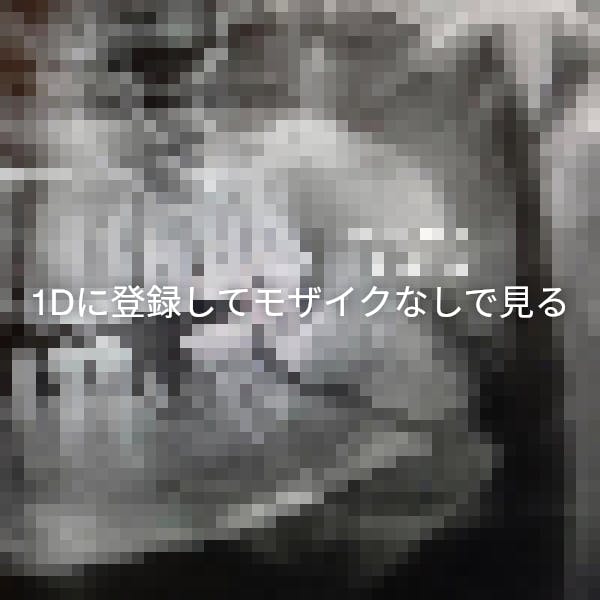 下顎骨骨折 1d歯科用語辞典 下顎骨骨折 1d歯科用語辞典