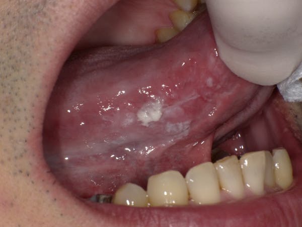 舌癌 1d歯科用語辞典