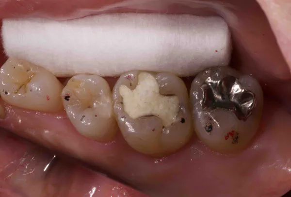 レジン修復 1d歯科用語集