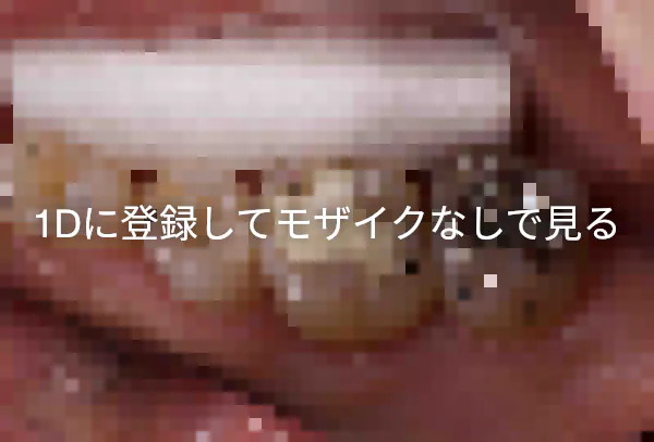 レジン修復 1d歯科用語集 レジン修復 1d歯科用語集