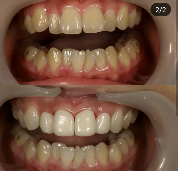 これもまた扁平苔癬 頬粘膜と15 16 17の歯肉の部分です ふわ ゆうさんの投稿 歯科医師 衛生士 技工士向けsns 情報サイト1d ワンディー