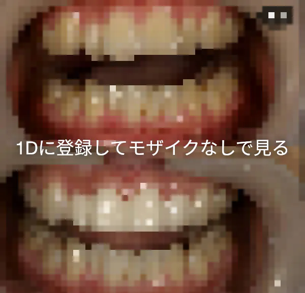 これもまた扁平苔癬 頬粘膜と15 16 17の歯肉の部分です ふわ ゆうさんの投稿 歯科医師 衛生士 技工士向けsns 情報サイト1d ワンディー