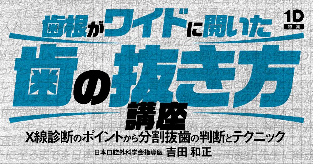 歯根がワイドに開いた歯の抜き方講座｜歯科オンラインセミナー・録画