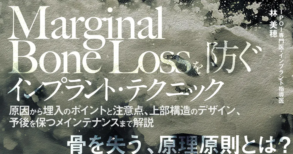 Marginal Bone Lossを防ぐインプラント・テクニック｜歯科オンライン