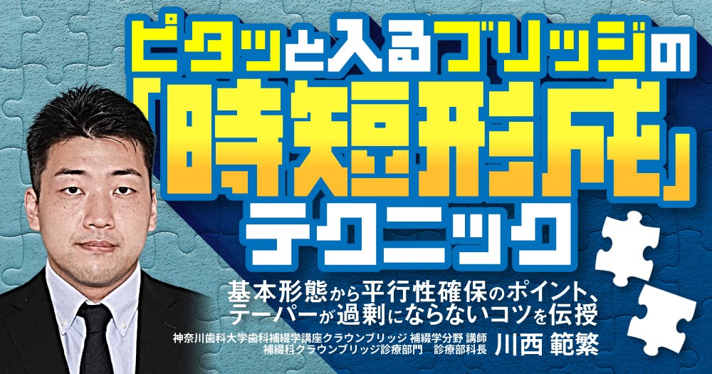 歯に優しいけどムズかしい、接着ブリッジの臨床論。デザイン