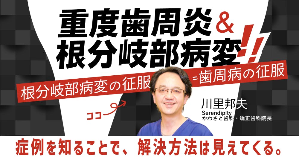 重度歯周炎&根分岐部病変の臨床。根分岐部病変を制する者は、歯周炎を
