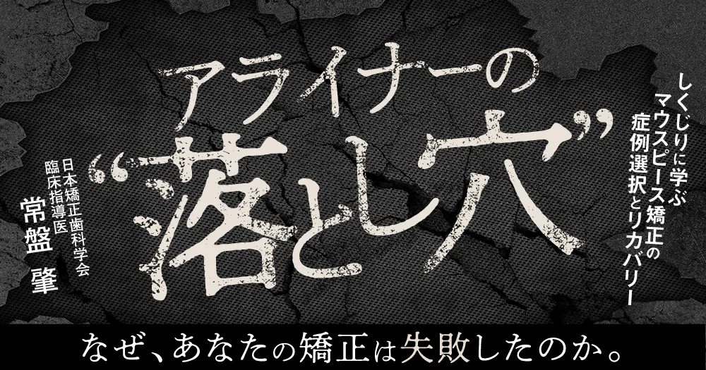 アライナーの