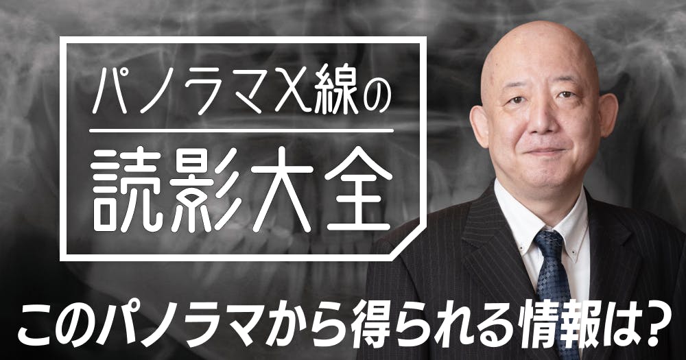 パノラマX線「読影」大全。X線診断について解説｜歯科オンライン
