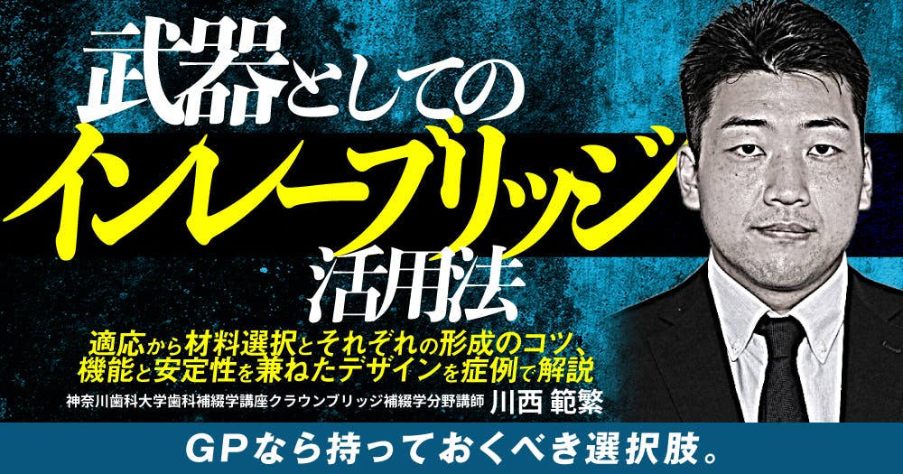 接着ブリッジ講座 oy7stiLIWKAwGxQFNnlfmvnT3B7eEW