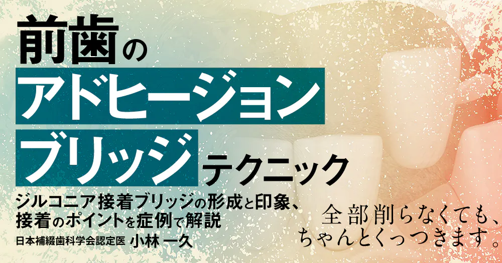 接着ブリッジ講座 前歯の「アドヒージョンブリッジ」テクニック｜歯科オンラインセミナー