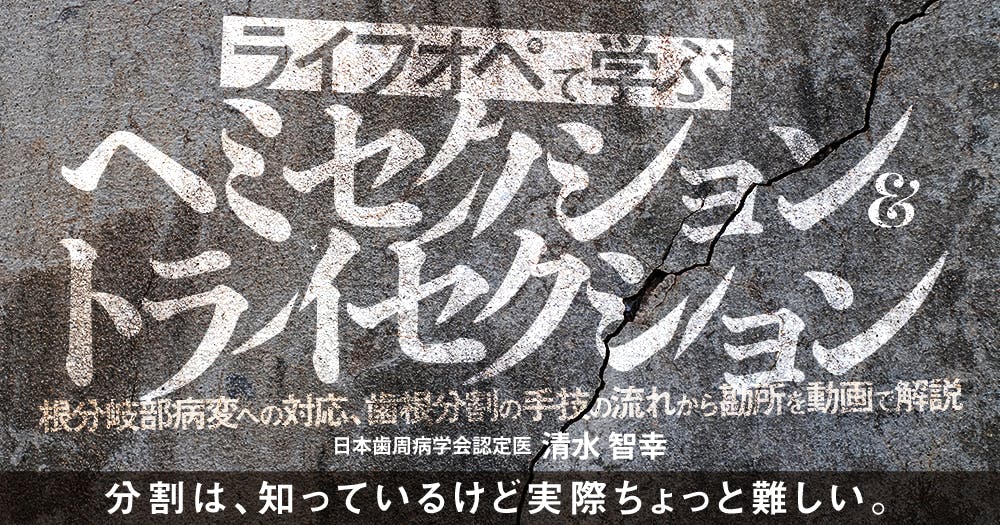 ライブオペで学ぶ「ヘミセクション&トライセクション」｜歯科
