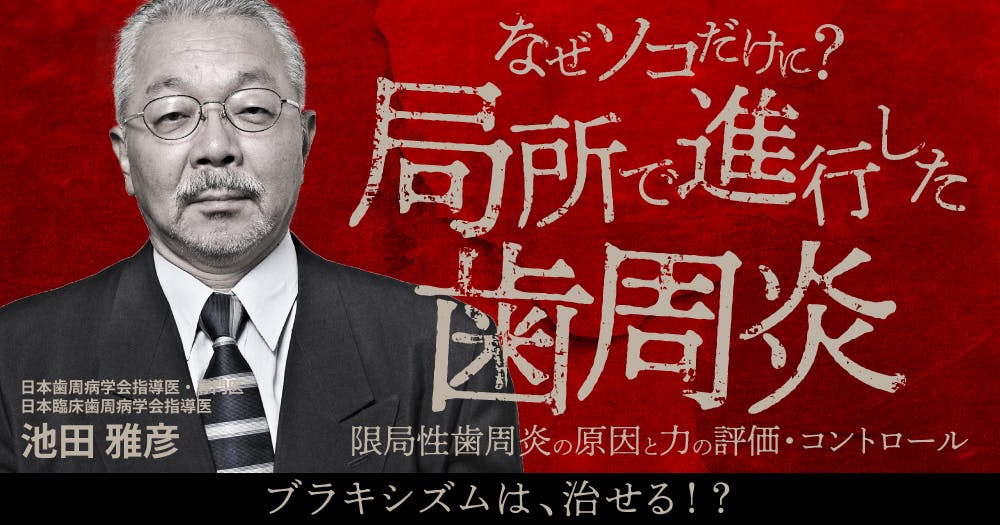 なぜソコだけに？局所で進行した歯周炎。限局性歯周炎の原因と力の評価