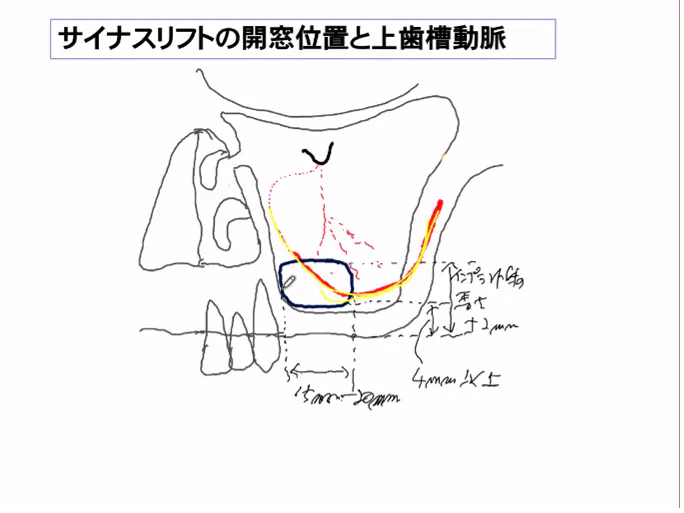 1d的セミナーログ サイナスリフトの基礎知識と起こり得る偶発症 歯科医師 衛生士 技工士向けsns 情報サイト1d ワンディー